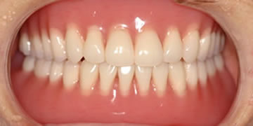 義歯治療-3